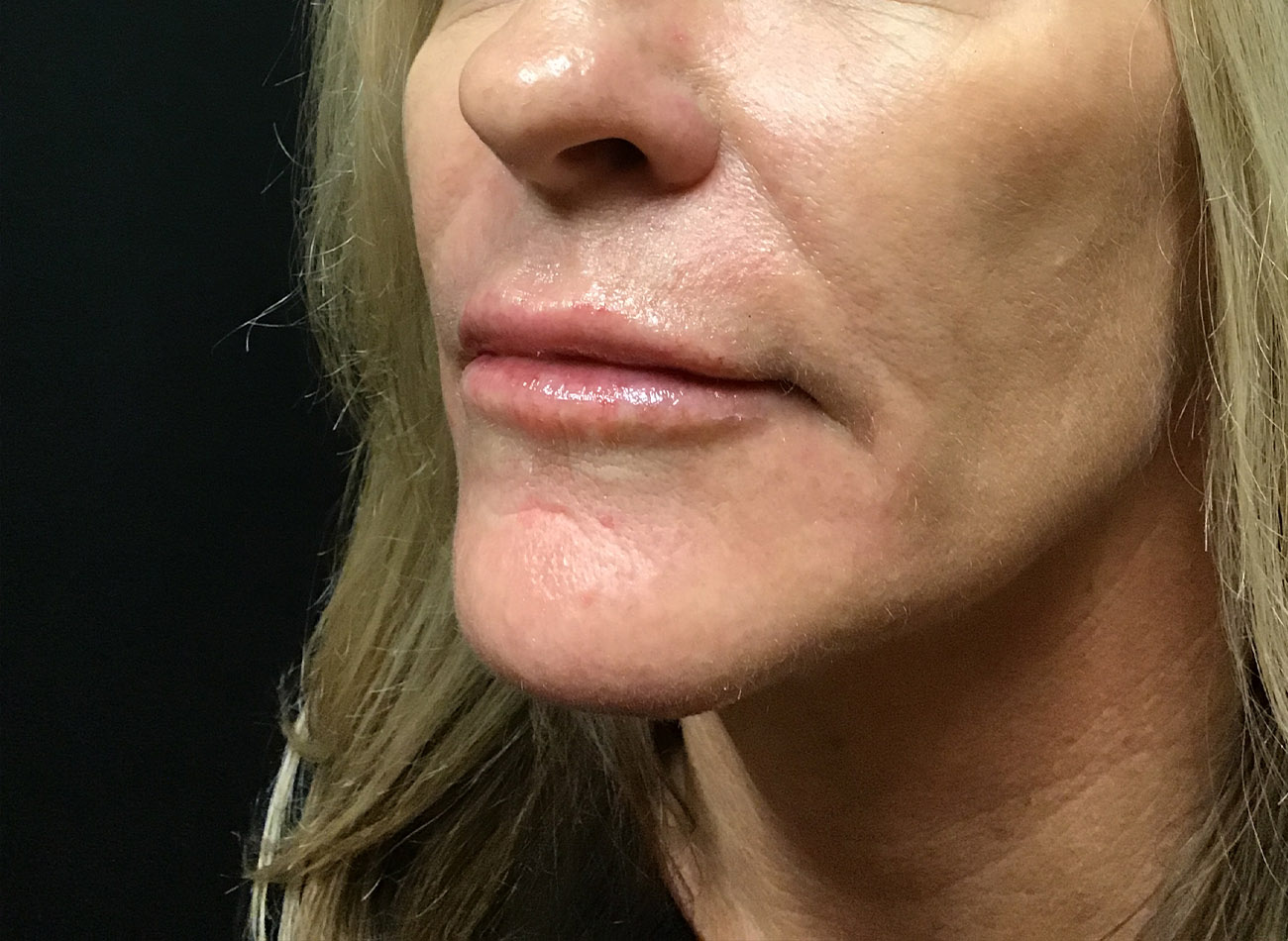 Patient #38884: Volbella After Image