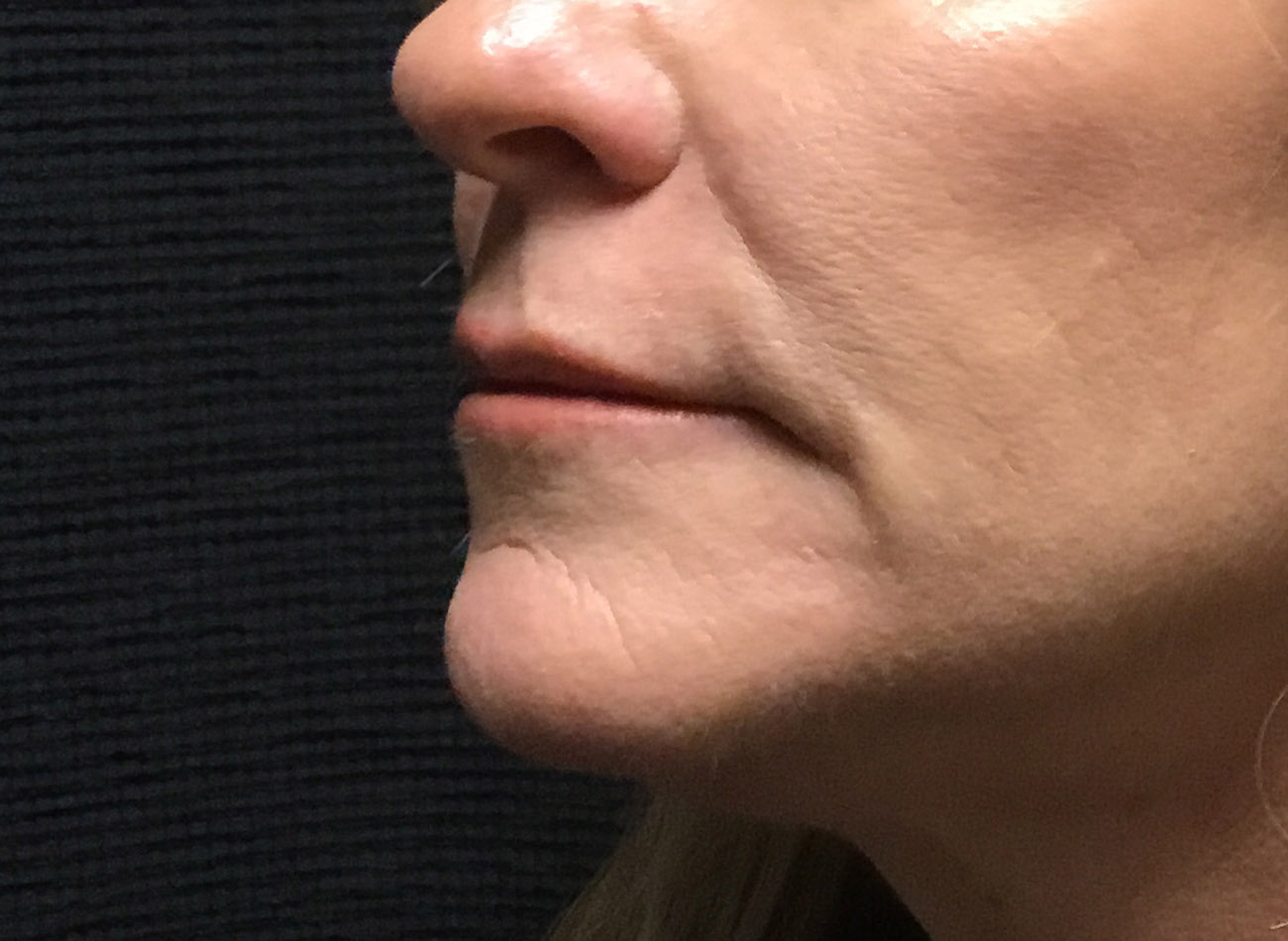 Patient #38884: Volbella Before Image