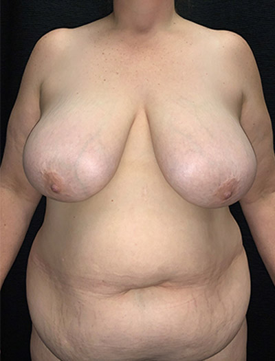 Patient #14773: Mommy Makeover Before Image