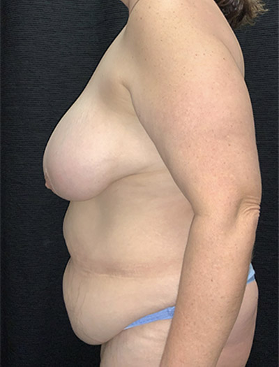 Patient #14773: Mommy Makeover Before Image