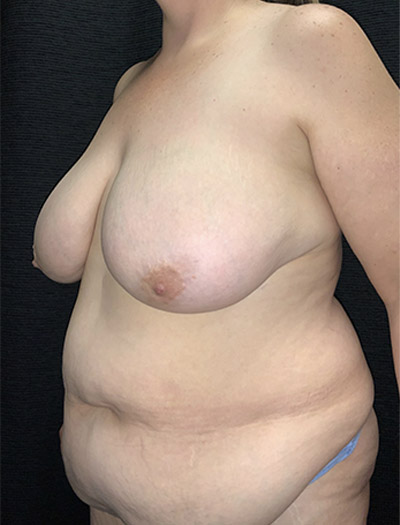 Patient #14773: Mommy Makeover Before Image