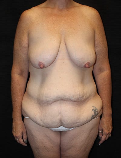 Patient #37012: Mommy Makeover Before Image