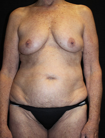 Patient #38510: Mommy Makeover Before Image