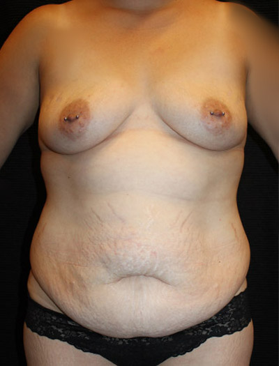 Patient #42015: Mommy Makeover Before Image