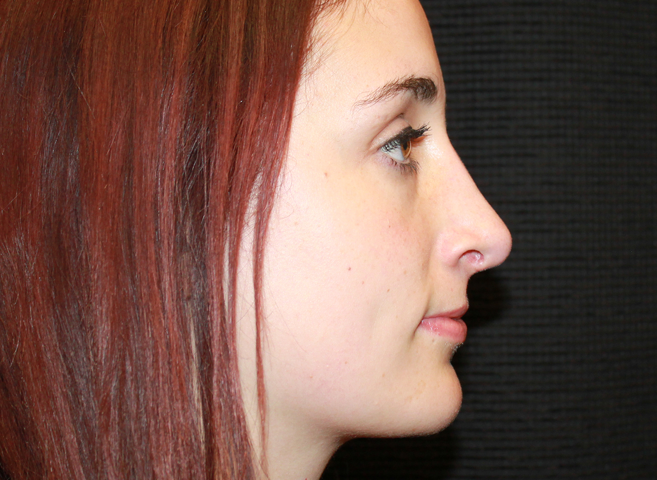 Patient #24348: Rhinoplasty After Image