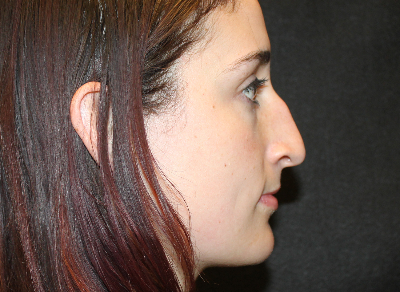 Patient #24348: Rhinoplasty Before Image