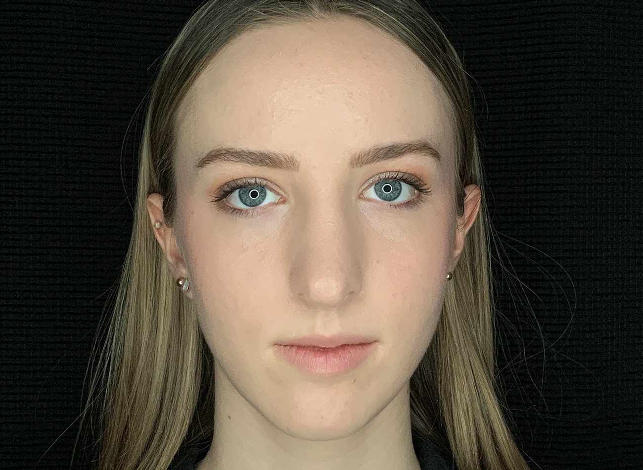 Patient #54893: Rhinoplasty After Image