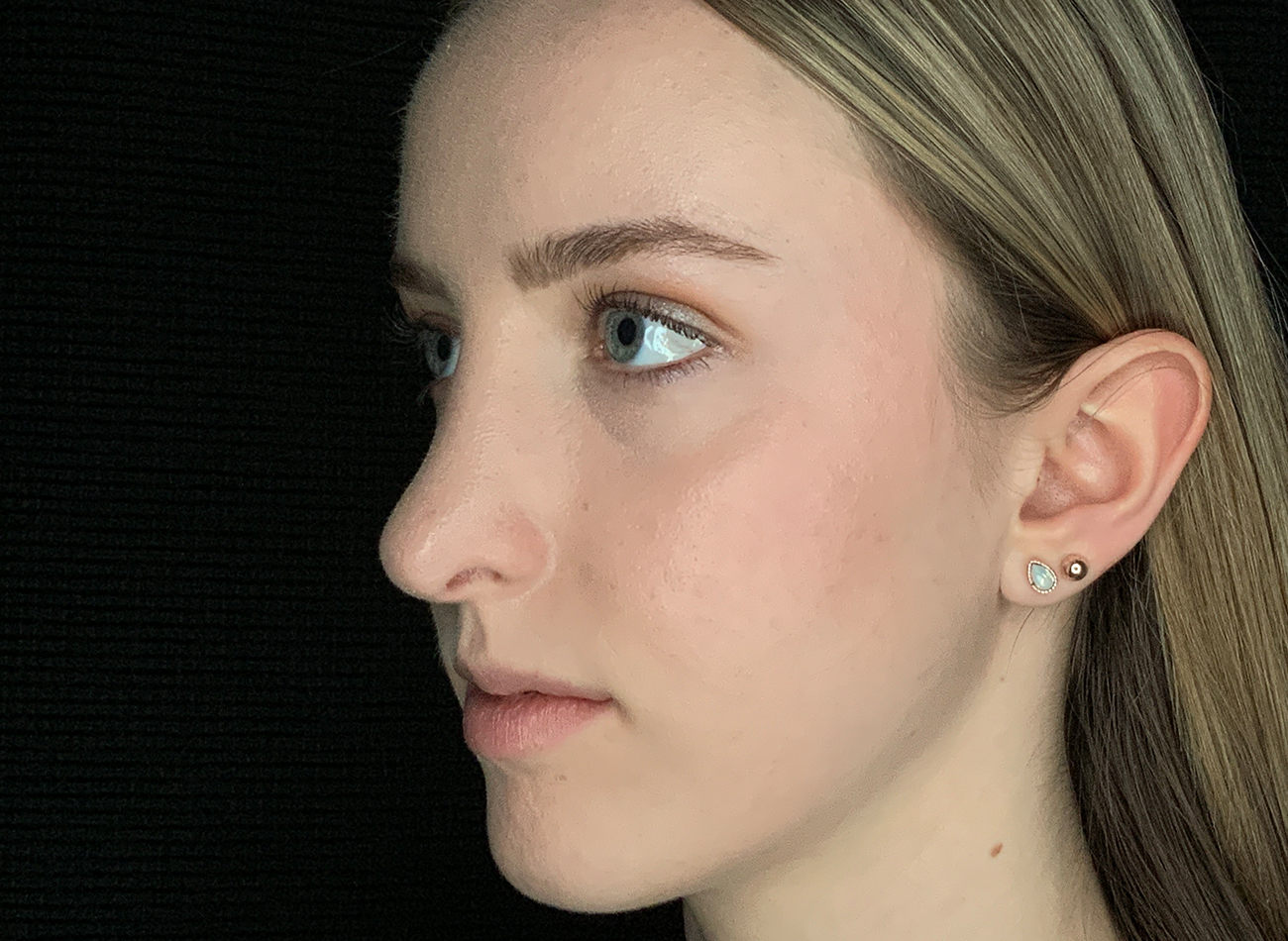 Patient #54893: Rhinoplasty After Image