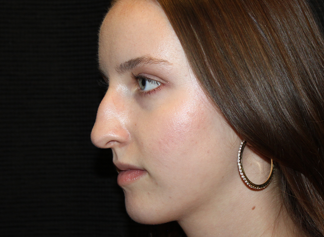 Patient #54893: Rhinoplasty Before Image