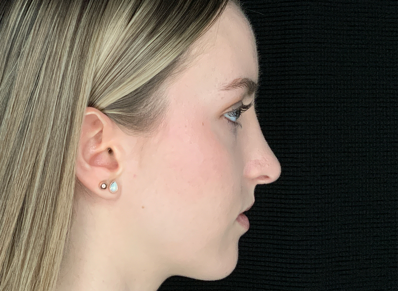 Patient #54893: Rhinoplasty After Image