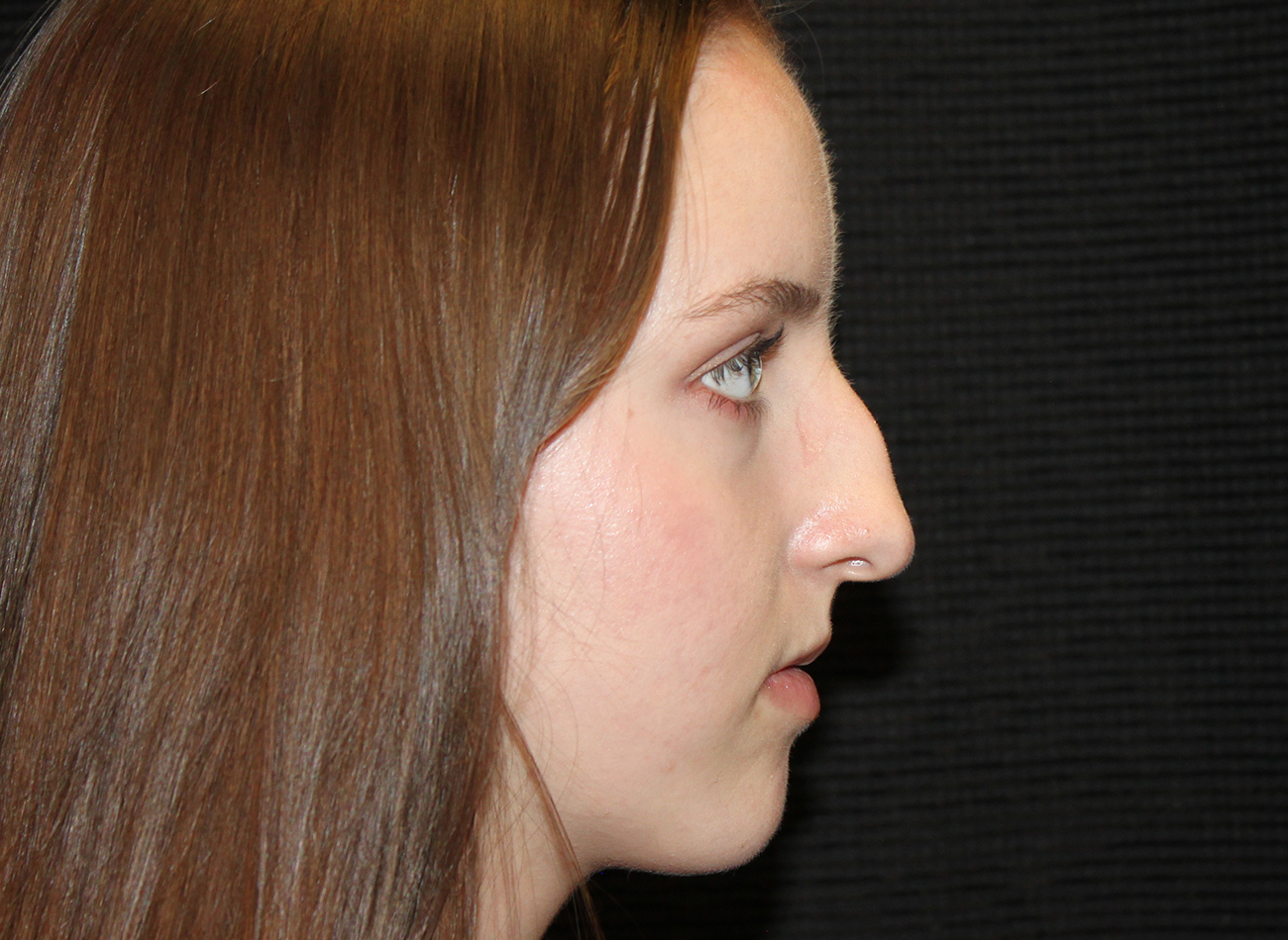 Patient #54893: Rhinoplasty Before Image