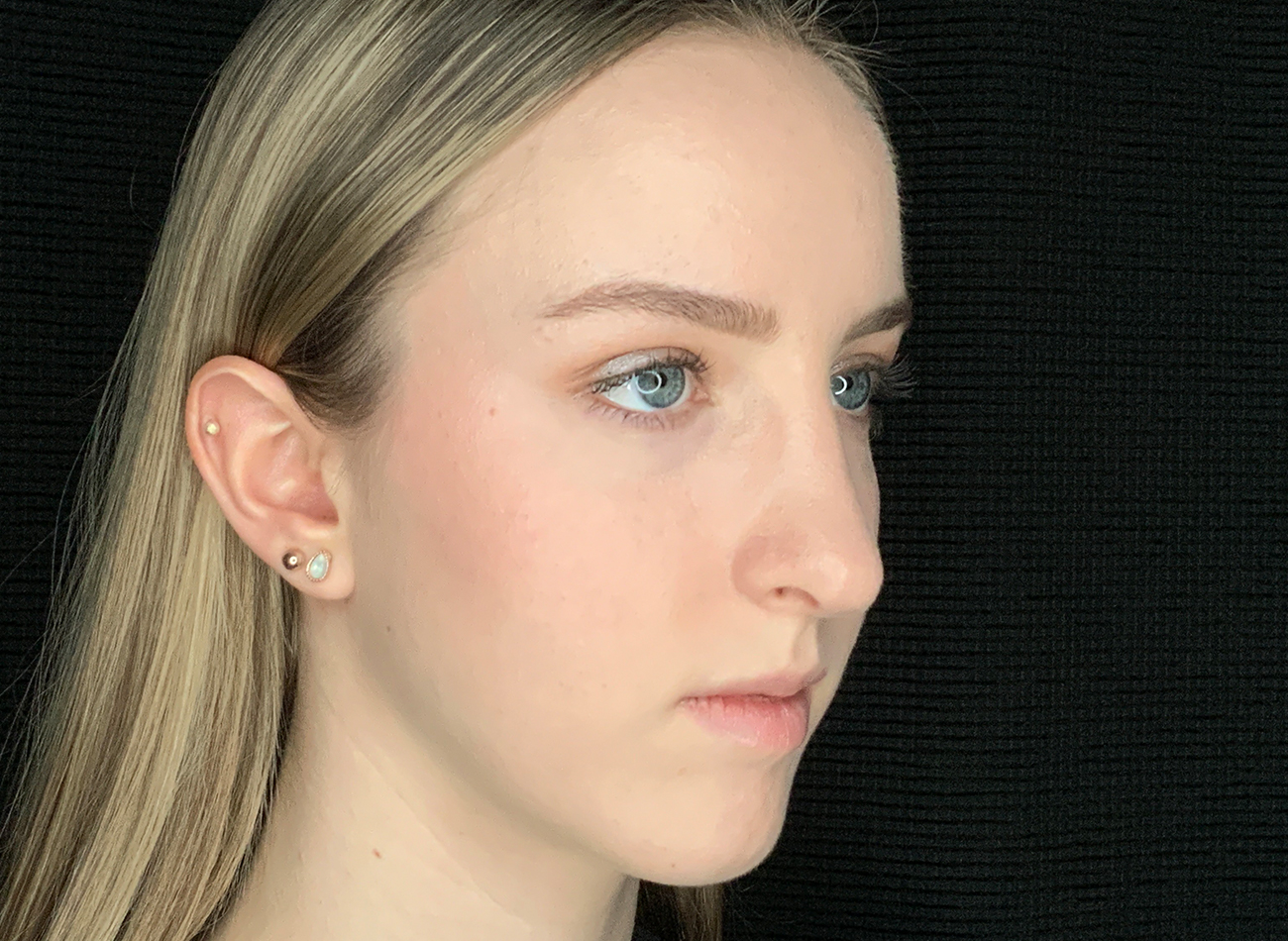 Patient #54893: Rhinoplasty After Image