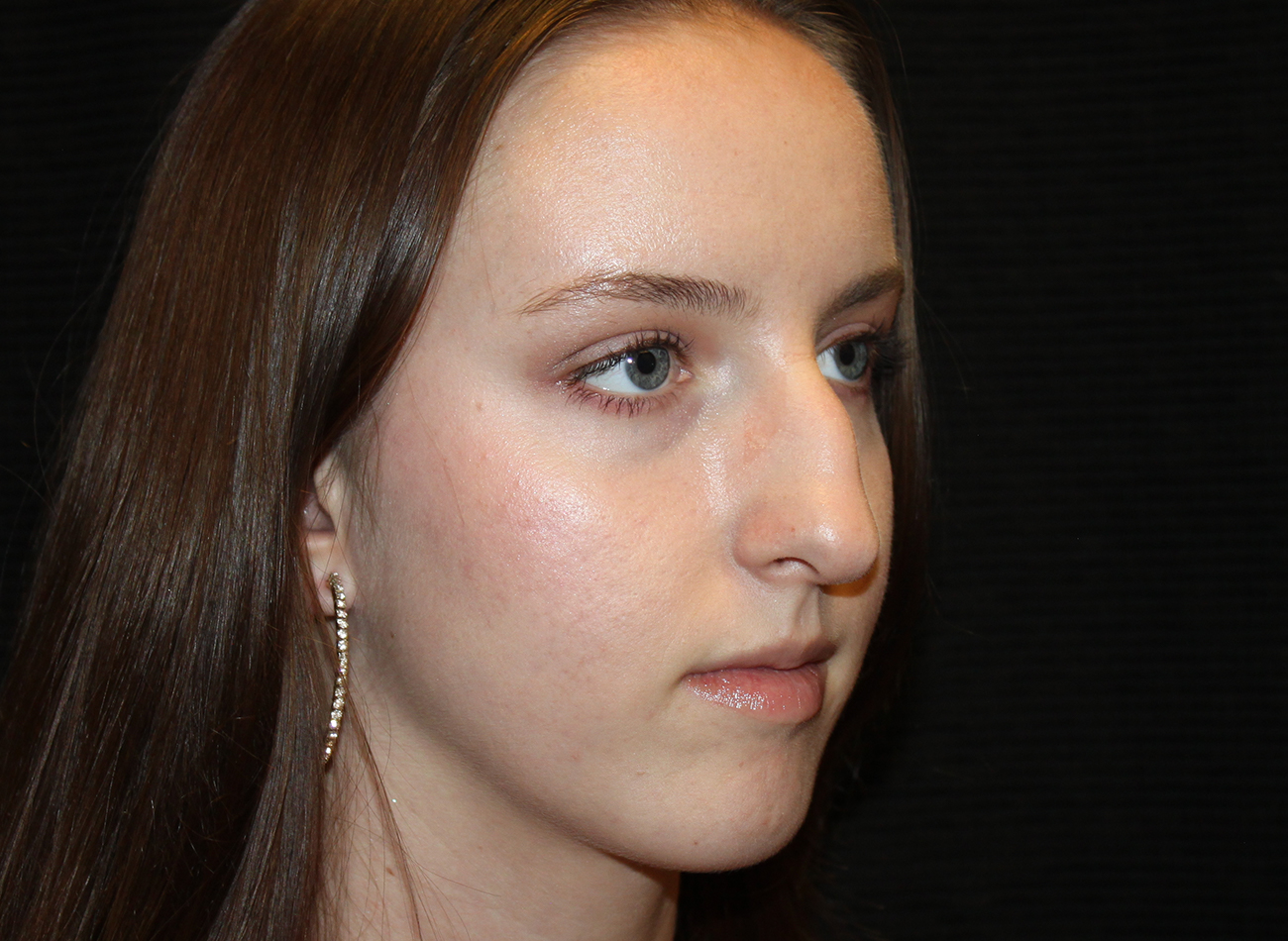 Patient #54893: Rhinoplasty Before Image