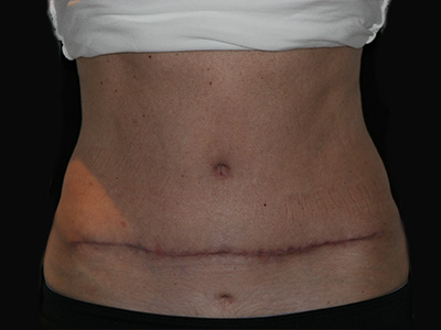 Patient #07982: Tummy Tuck After Image
