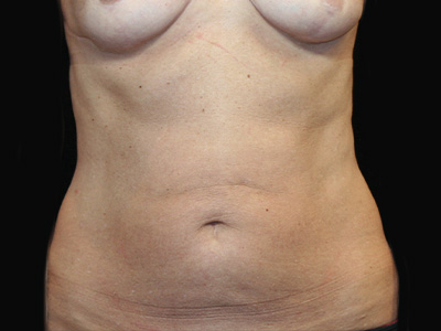 Patient #07982: Tummy Tuck Before Image