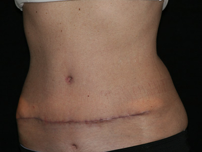 Patient #07982: Tummy Tuck After Image