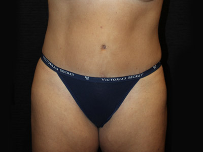 Patient #19316-1: Tummy Tuck with Liposuction After Image