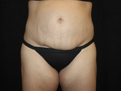 Patient #19316-1: Tummy Tuck with Liposuction Before Image