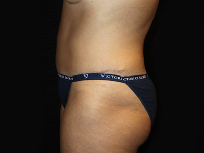 Patient #19316-1: Tummy Tuck with Liposuction After Image