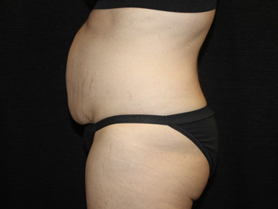 Patient #19316-1: Tummy Tuck with Liposuction Before Image