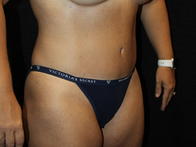 Patient #19316-1: Tummy Tuck with Liposuction After Image