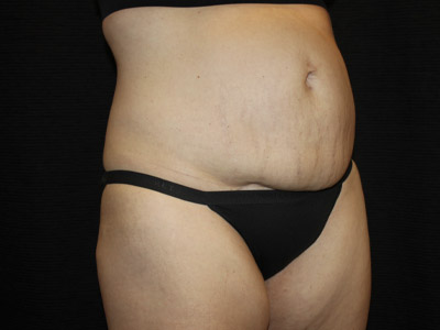 Patient #19316-1: Tummy Tuck with Liposuction Before Image
