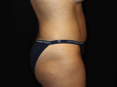 Patient #19316-1: Tummy Tuck with Liposuction After Image