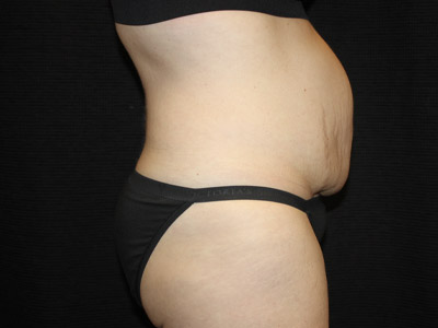 Patient #19316-1: Tummy Tuck with Liposuction Before Image