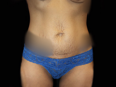 Patient #21454: Tummy Tuck Before Image