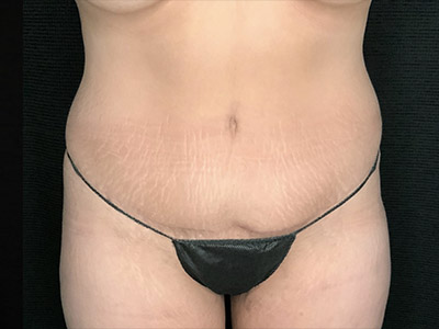 Patient #22337: Tummy Tuck with Liposuction After Image