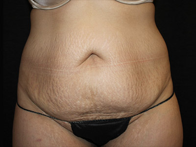 Patient #22337: Tummy Tuck with Liposuction Before Image