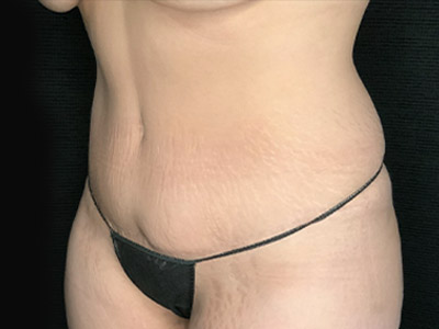 Patient #22337: Tummy Tuck with Liposuction After Image