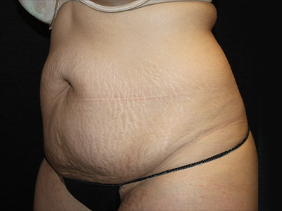 Patient #22337: Tummy Tuck with Liposuction Before Image