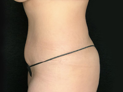 Patient #22337: Tummy Tuck with Liposuction After Image