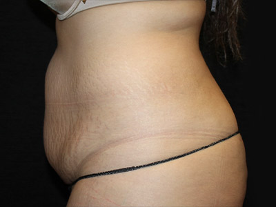 Patient #22337: Tummy Tuck with Liposuction Before Image