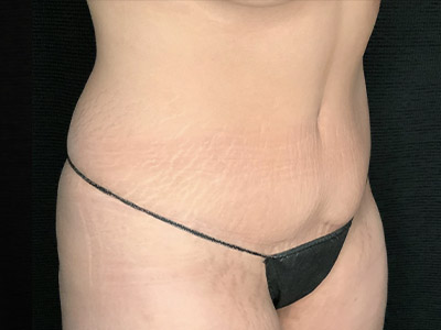 Patient #22337: Tummy Tuck with Liposuction After Image
