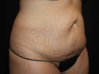Patient #22337: Tummy Tuck with Liposuction Before Image