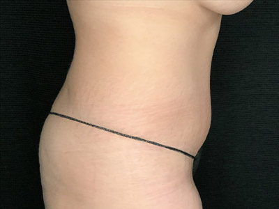 Patient #22337: Tummy Tuck with Liposuction After Image