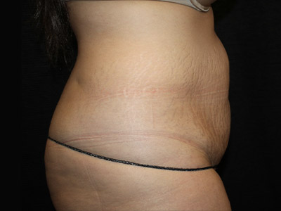 Patient #22337: Tummy Tuck with Liposuction Before Image