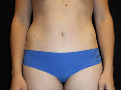 Paciente n.° 22703: Imagen posterior a la abdominoplastia