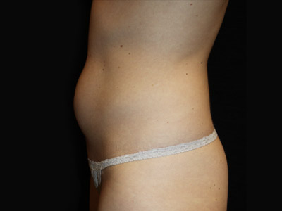 Paciente n.° 22703: Imagen previa a la abdominoplastia