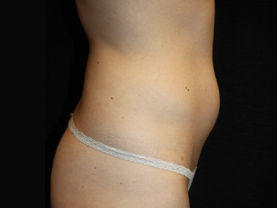 Paciente n.° 22703: Imagen previa a la abdominoplastia