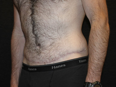 Patient #26019: Tummy Tuck After Image