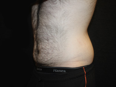 Patient #26019: Tummy Tuck Before Image