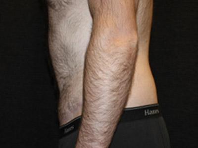 Patient #26019: Tummy Tuck After Image