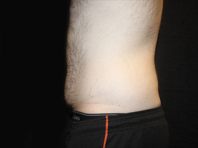 Patient #26019: Tummy Tuck Before Image