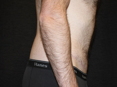 Patient #26019: Tummy Tuck After Image