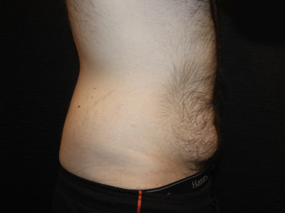 Patient #26019: Tummy Tuck Before Image