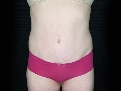Patient #31151: Tummy Tuck After Image