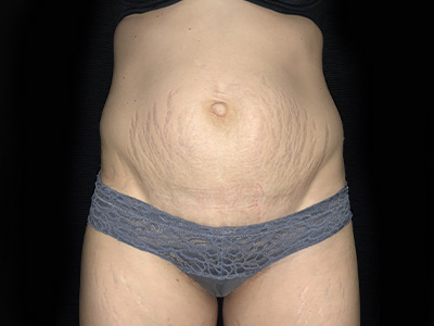 Patient #31151: Tummy Tuck Before Image